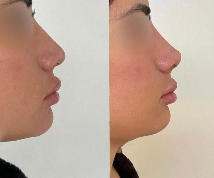 Rinomodelación con ácido hialurónico